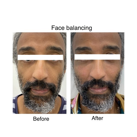 Before and after cheek filler, supplied by Dr. Zaheer Abbas