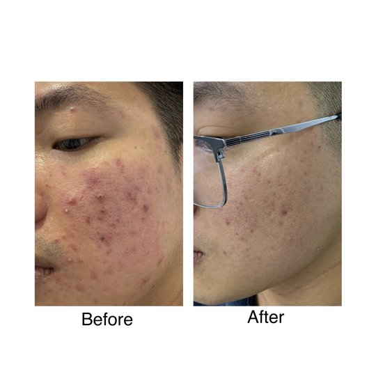 Before and after chemical peel, supplied by Dr. Zaheer Abbas