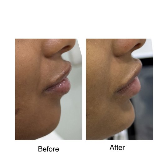 Before and after chin augmentation, supplied by Dr. Zaheer Abbas