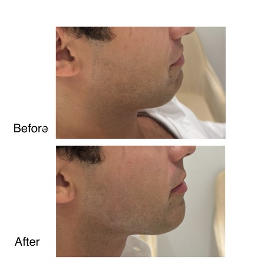 Before and after chin augmentation, supplied by Dr. Zaheer Abbas