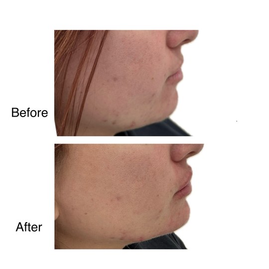 Before and after chin augmentation, supplied by Dr. Zaheer Abbas