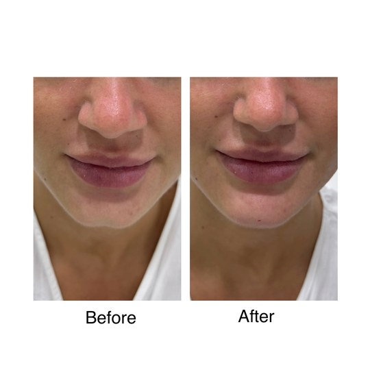 Before and after chin filler, supplied by Dr. Zaheer Abbas