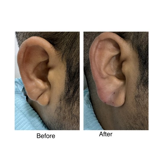 Before and after earlobe filler, supplied by Dr. Zaheer Abbas