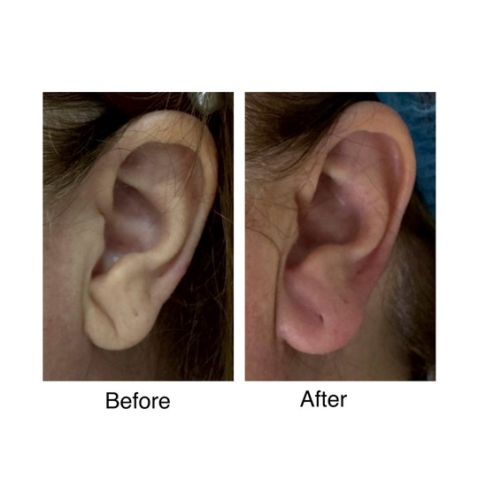 Before and after earlobe filler, supplied by Dr. Zaheer Abbas
