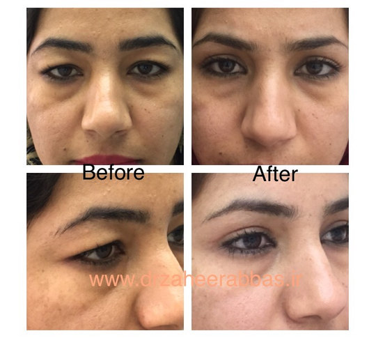Before and after upper eyelid surgery from Dr. Zaheer Abbas’s procedure gallery