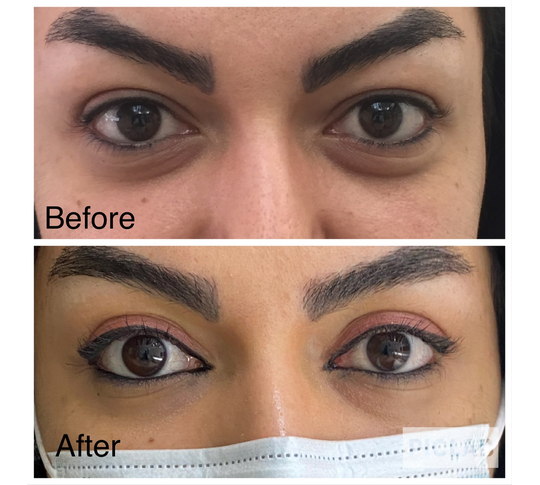 Before and after upper eyelid surgery from Dr. Zaheer Abbas’s procedure gallery
