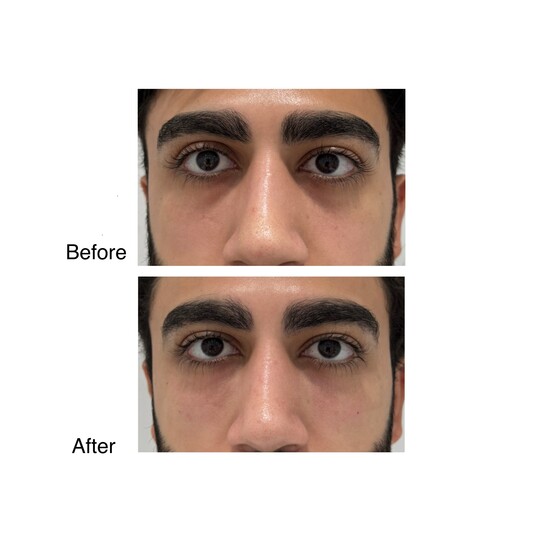 Before and after under-eye filler, supplied by Dr. Zaheer Abbas