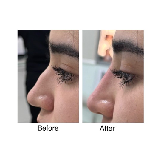 Before and after nose filler, supplied by Dr. Zaheer Abbas