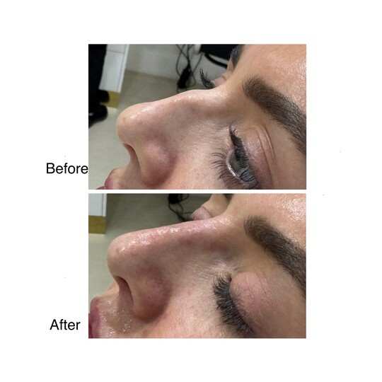 Before and after nose filler, supplied by Dr. Zaheer Abbas