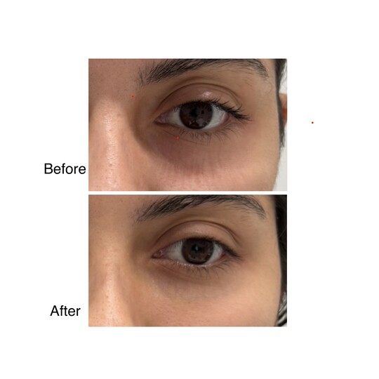 Before and after under-eye filler, supplied by Dr. Zaheer Abbas