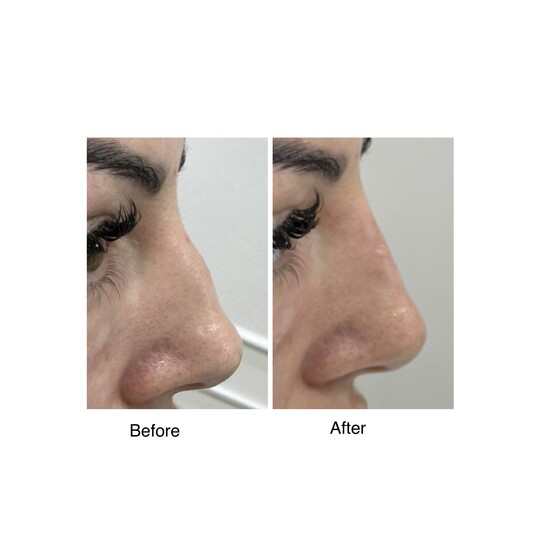 Before and after nose filler, supplied by Dr. Zaheer Abbas