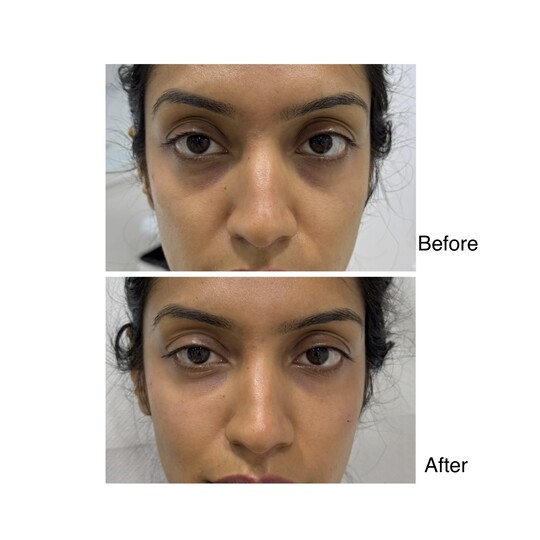 Before and after under-eye filler, supplied by Dr. Zaheer Abbas