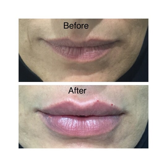 Before and after lip filler, supplied by Dr. Zaheer Abbas
