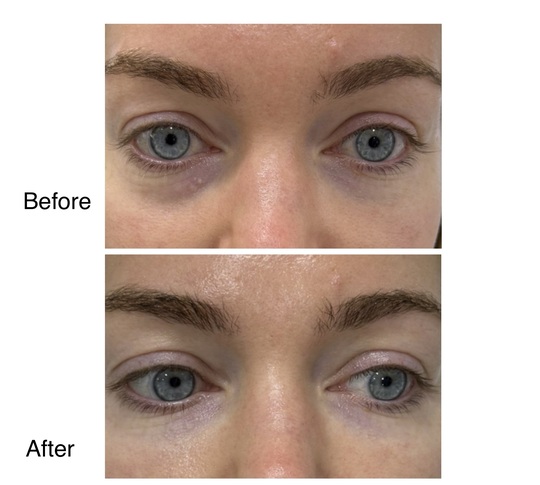 Under eye treatment: before and after from Dr. Abbas’s gallery