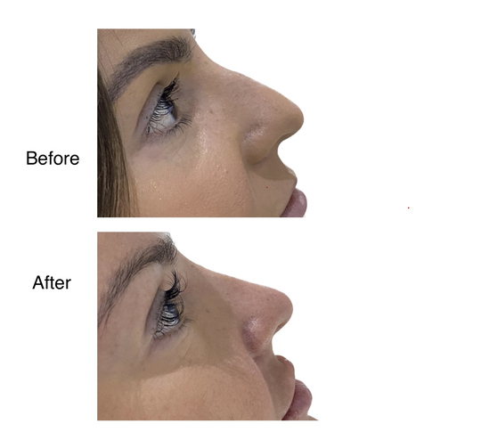 Before and after nose filler from Dr. Zaheer Abbas’s procedure gallery