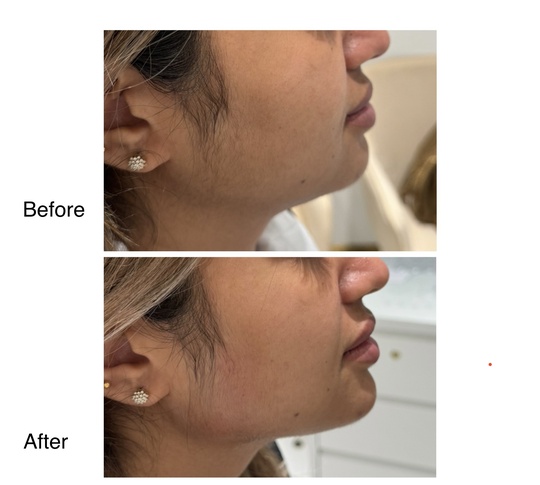 Jawline definition: before and after from Dr. Abbas’s gallery