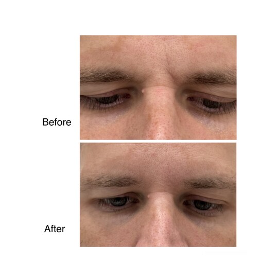 Before and after frown line filler, supplied by Dr. Zaheer Abbas
