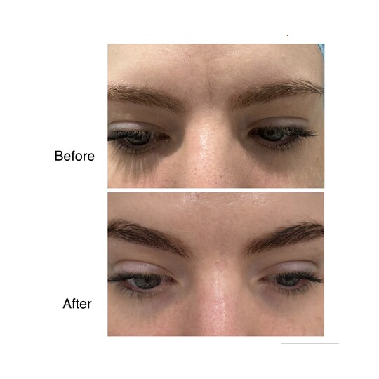 Before and after frown line filler, supplied by Dr. Zaheer Abbas