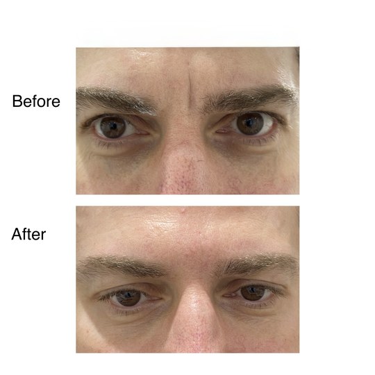 Before and after frown line filler, supplied by Dr. Zaheer Abbas