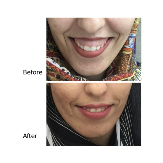 Before and after gummy smile correction, supplied by Dr. Zaheer Abbas