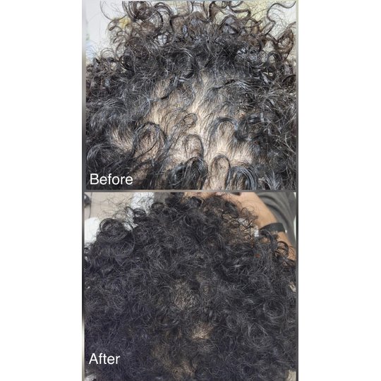 Before and after prp hair treatment, supplied by Dr. Zaheer Abbas