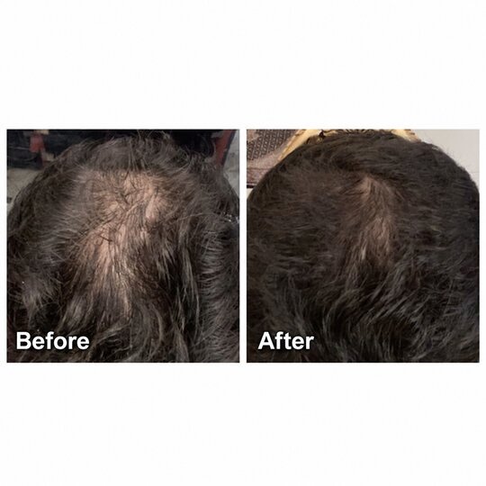 Before and after prp hair treatment, supplied by Dr. Zaheer Abbas