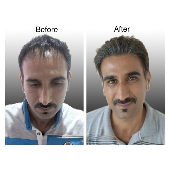 Before and after hair transplant, supplied by Dr. Zaheer Abbas