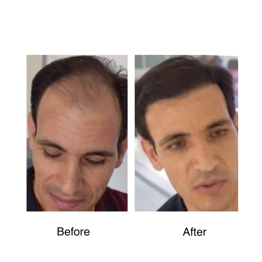Before and after hair transplant, supplied by Dr. Zaheer Abbas