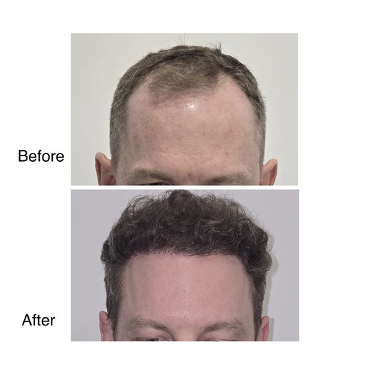 Before and after hair transplant, supplied by Dr. Zaheer Abbas