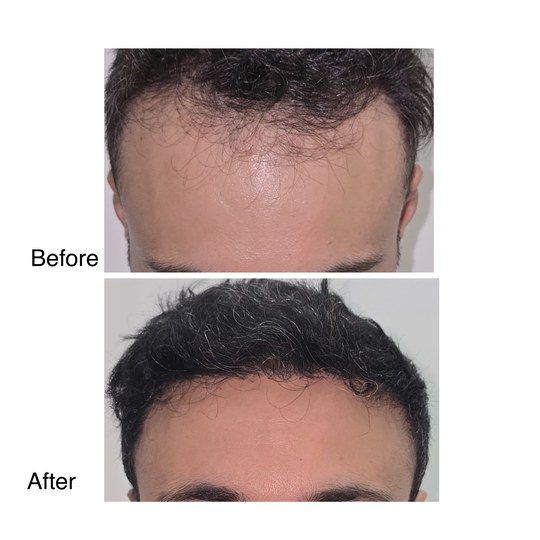 Before and after hair transplant, supplied by Dr. Zaheer Abbas