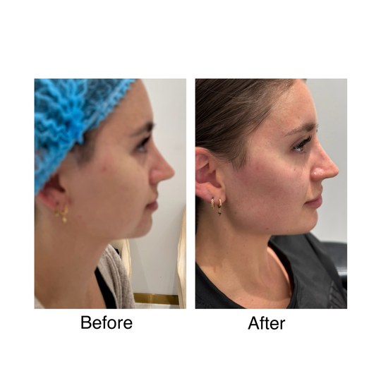 Before and after jawline filler, supplied by Dr. Zaheer Abbas