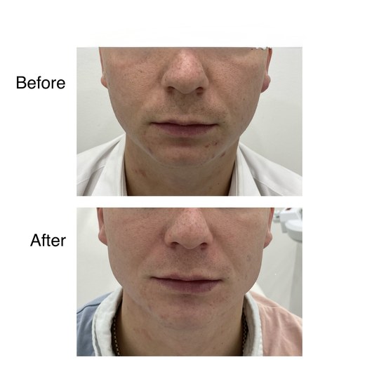 Before and after jawline filler, supplied by Dr. Zaheer Abbas