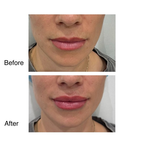 Before and after lip filler, supplied by Dr. Zaheer Abbas