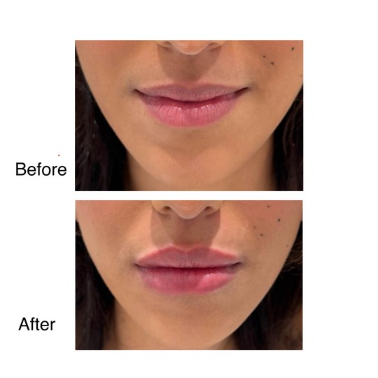 Before and after lip filler, supplied by Dr. Zaheer Abbas