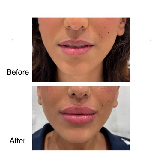 Before and after lip filler, supplied by Dr. Zaheer Abbas