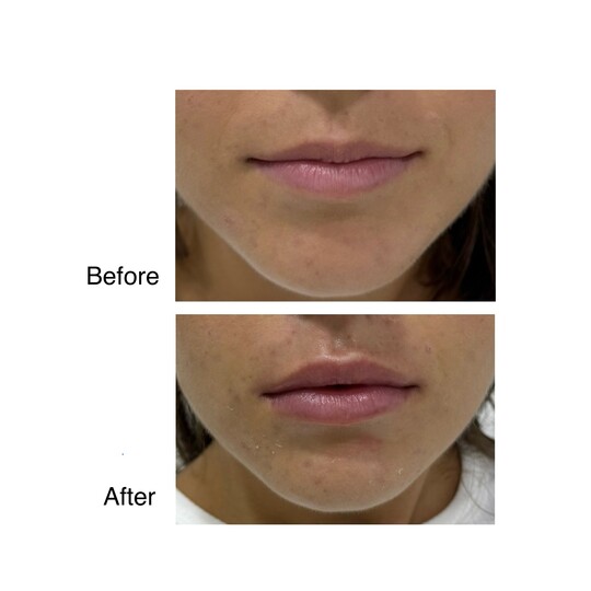 Before and after lip filler, supplied by Dr. Zaheer Abbas