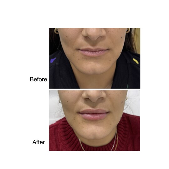 Before and after lip filler, supplied by Dr. Zaheer Abbas