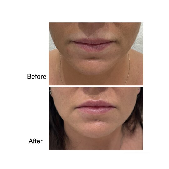 Before and after lip filler, supplied by Dr. Zaheer Abbas