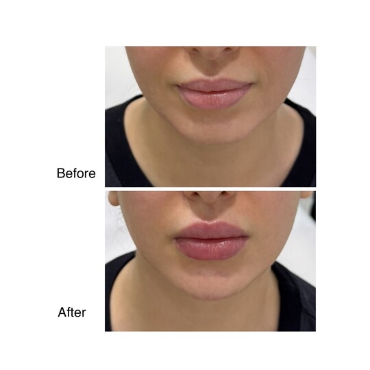 Before and after lip filler, supplied by Dr. Zaheer Abbas