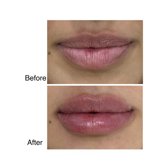 Before and after lip filler, supplied by Dr. Zaheer Abbas