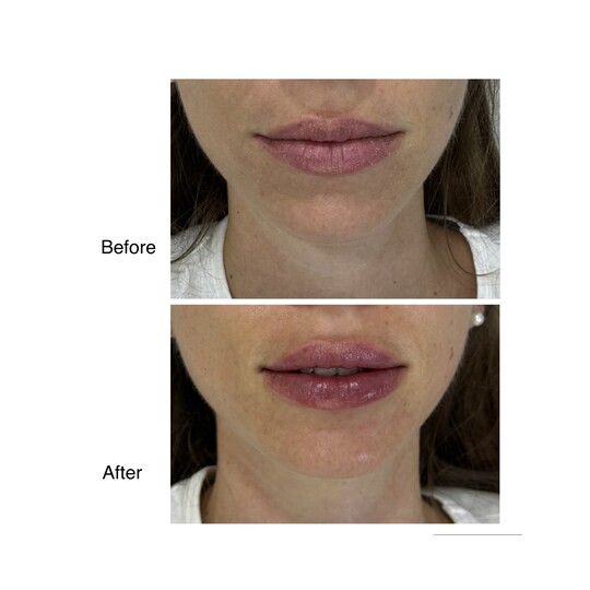 Before and after lip filler, supplied by Dr. Zaheer Abbas