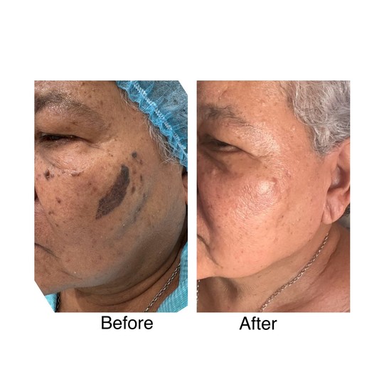 Before and after minor skin surgery, supplied by Dr. Zaheer Abbas
