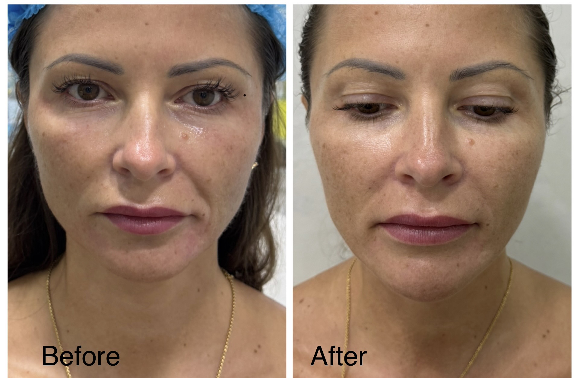 Before and after Radiesse facial rejuvenation, supplied by Dr. Zaheer Abbas
