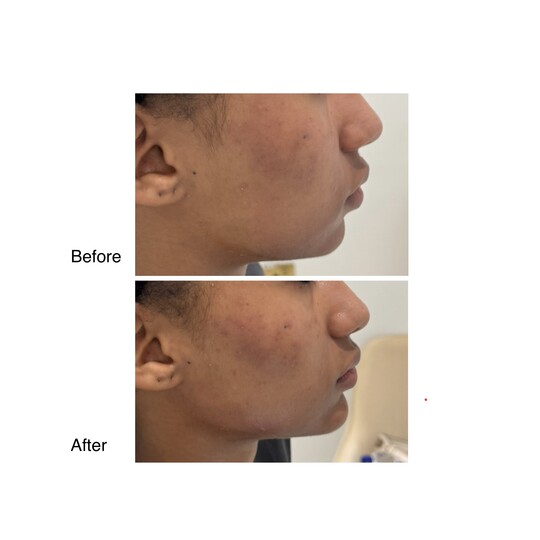 Before and after Jawline, supplied by Dr. Zaheer Abbas