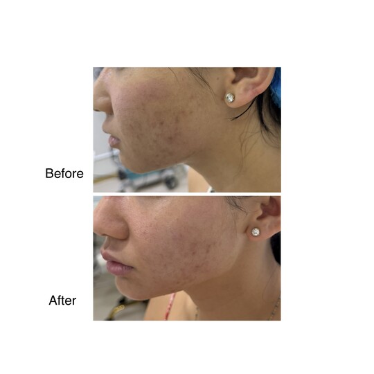 Before and after Jawline, supplied by Dr. Zaheer Abbas