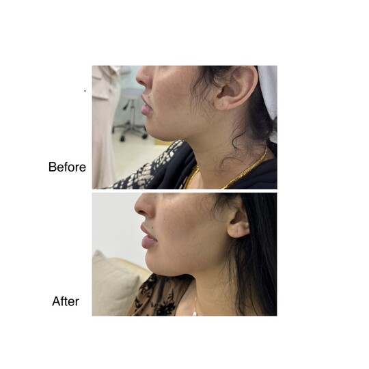 Before and after Jawline, supplied by Dr. Zaheer Abbas