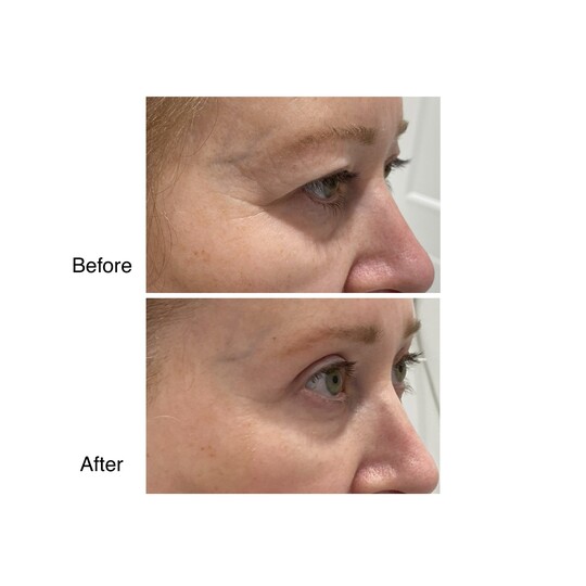 Before and after Blepharoplasty, supplied by Dr. Zaheer Abbas