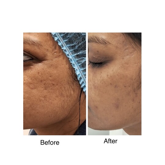 Before and after Acne scar treatment, supplied by Dr. Zaheer Abbas