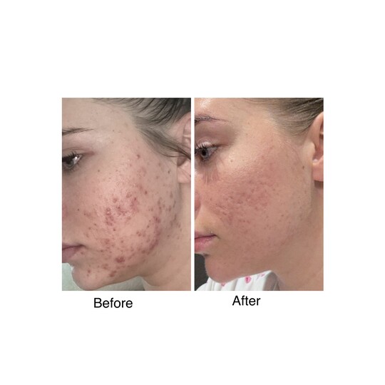Before and after Acne treatment · Roaccutane, supplied by Dr. Zaheer Abbas