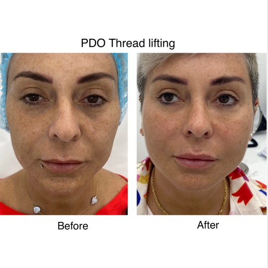 Before and after pdo thread lifting, supplied by Dr. Zaheer Abbas